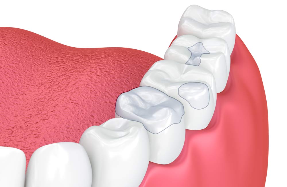 Illustration of inlays and onlays on teeth.