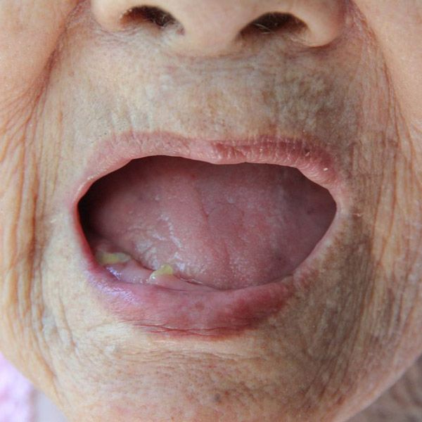 Patient missing almost all their teeth