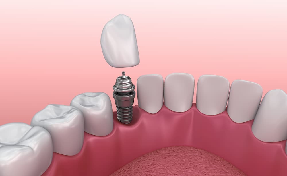 dental implant