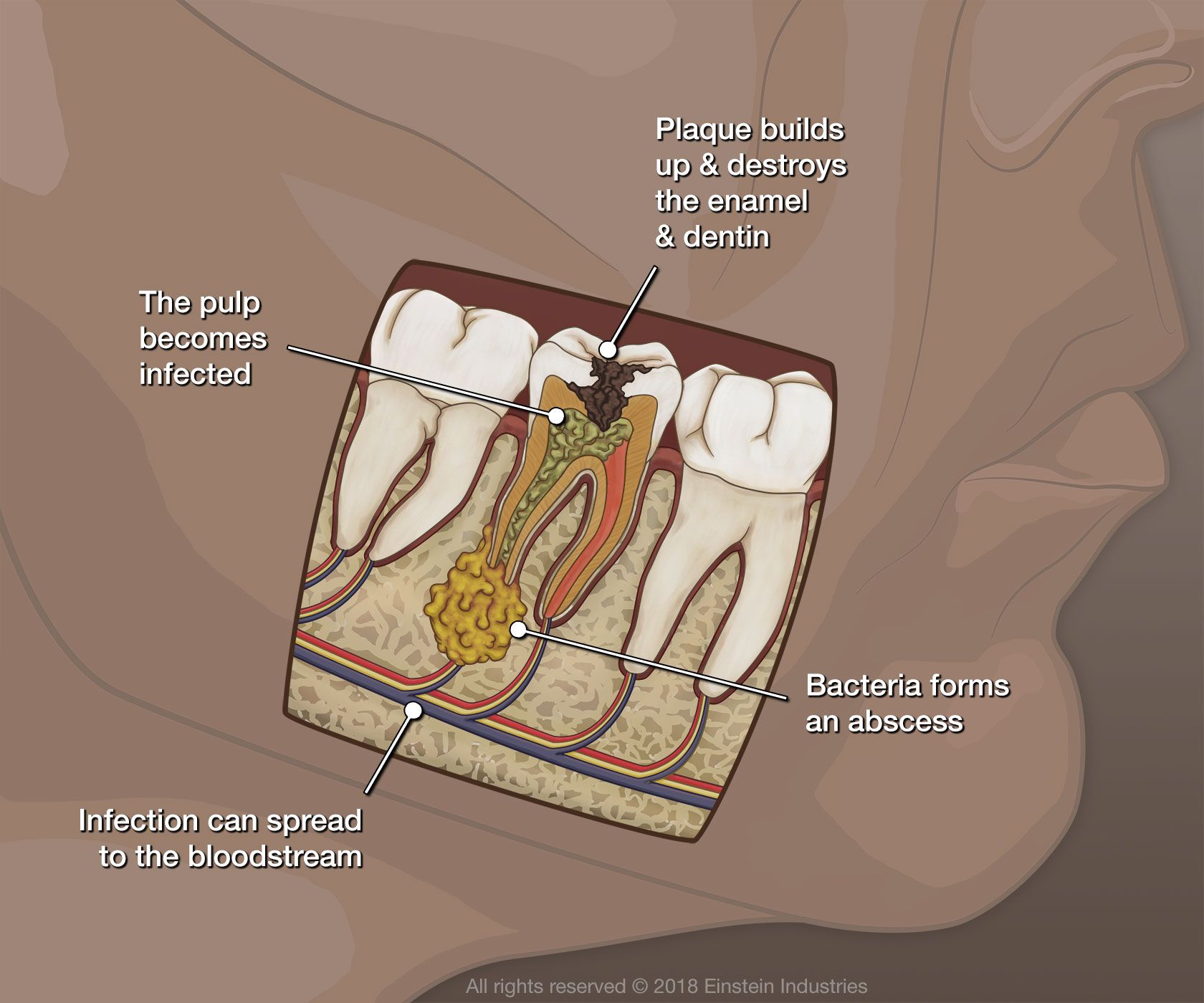 An illustration showing how root canal therapy works